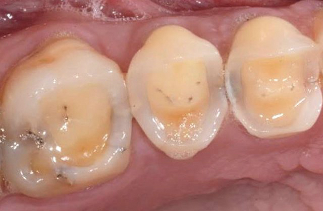 Reflusso gastro-esofageo e Erosione dentale: questione di Acidità - Studio dentistico Ferlin