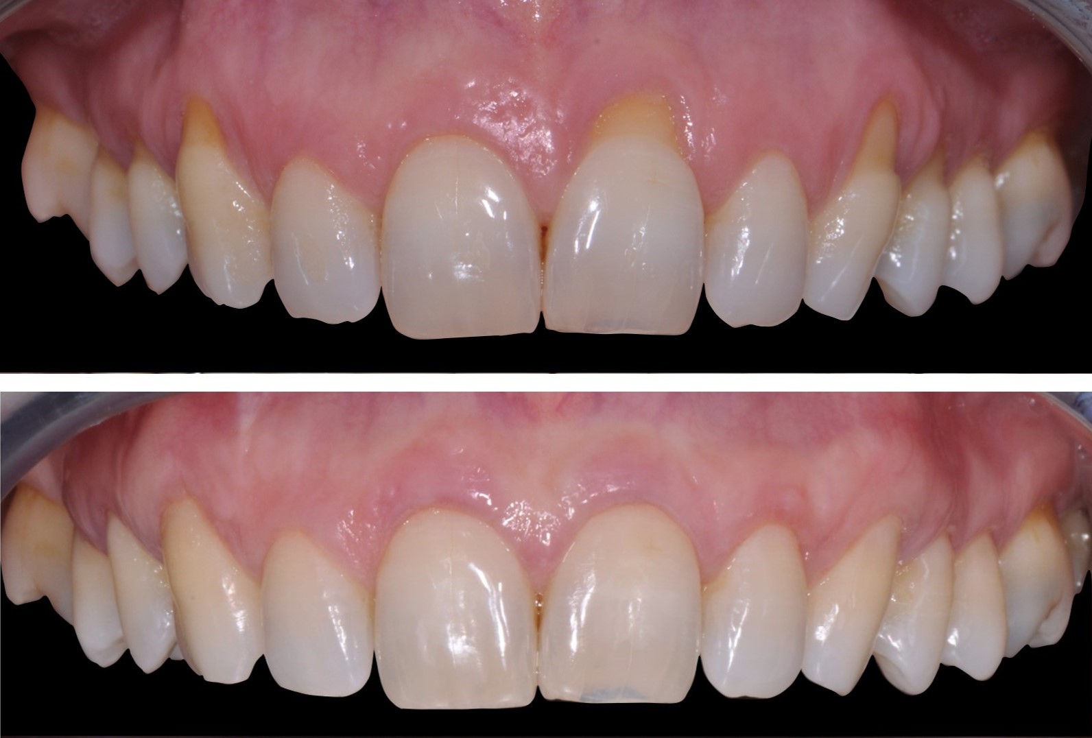 Gengive che si ritirano: si possono curare? - Ferlin Studio Dentistico
