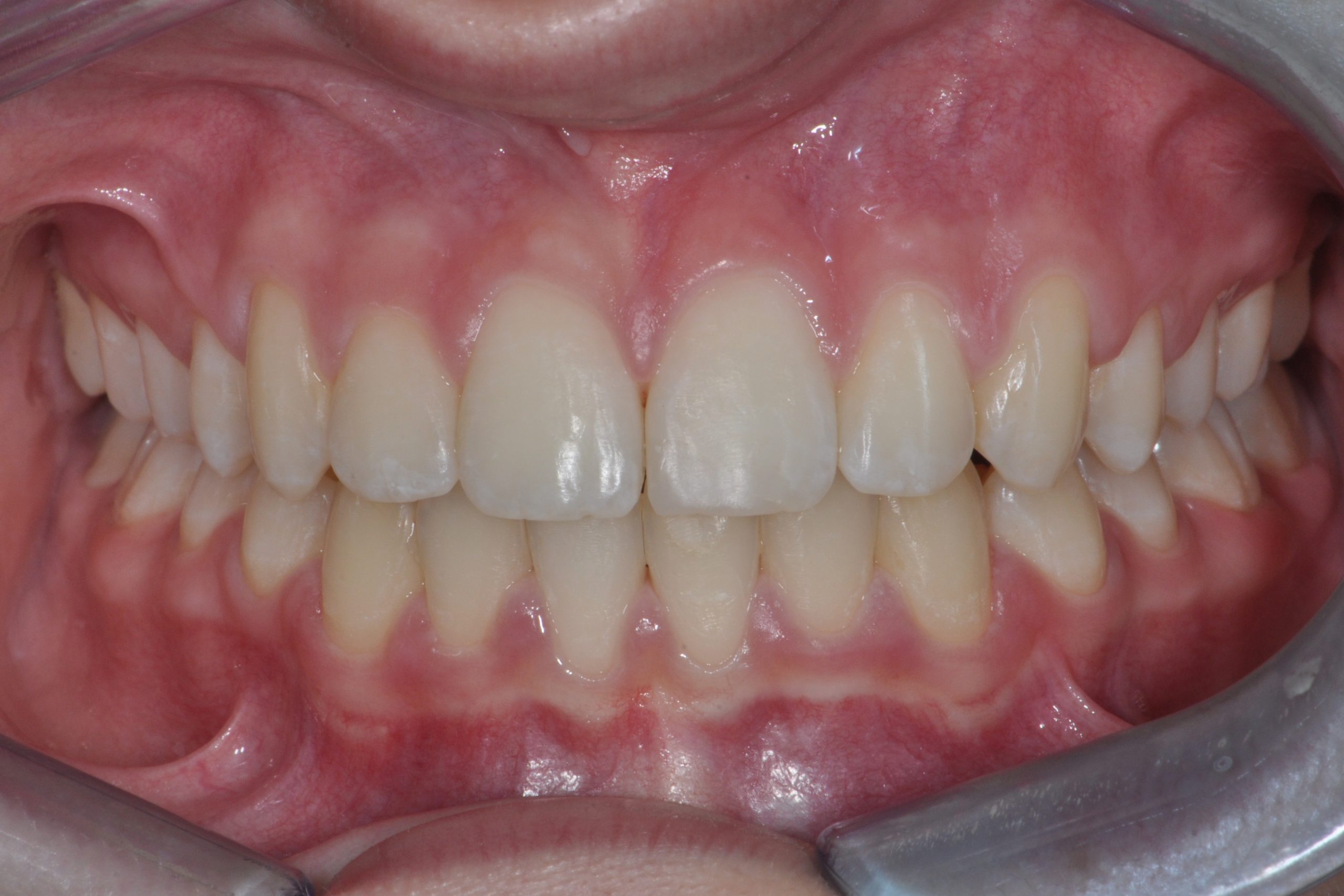 denti storti prima e dopo