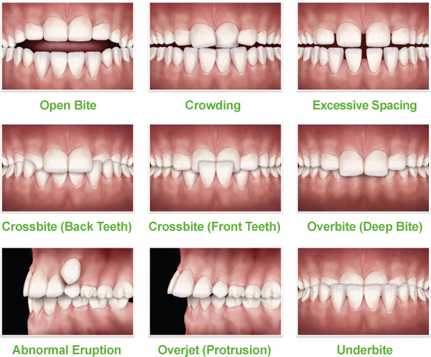 problemi ortodontici - Studio dentistico Ferlin