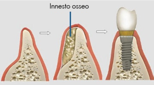 Rigenerazione ossea - Studio dentistico Ferlin - dentista a Legnago