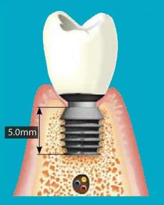 implantologia milazzo 061 - Studio dentistico Ferlin - dentista a Legnago